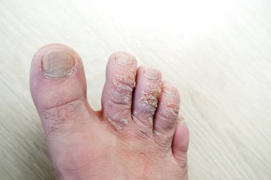 Parmaklarında nasır olan biri parmaklarını kaşır, kontrol eder, nasırlı parmakları vardır.,