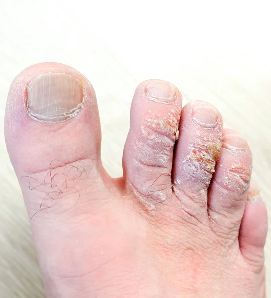 Заболевания Кожи Ног Грибковые Образования Пальцах Мозолистые Пальцы — стоковое фото