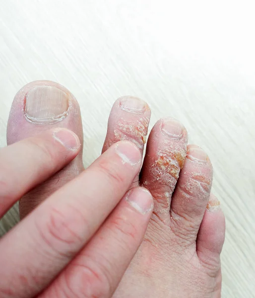 close-up foot skin diseases, callus formation on the fingers, calluses on the upper part of the toes,