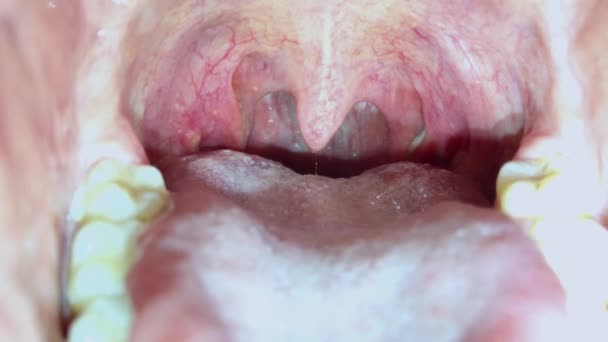 Dor de garganta de um adulto, Close up. Língua peluda cinzenta. Otorrinolaringologia. — Vídeo de Stock