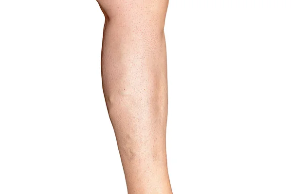 グレードC3 C4慢性静脈不全の女性の脚 ワリコース症候群 白い背景に隔離された脚の写真 — ストック写真