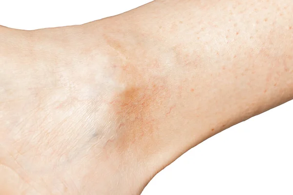 Ankle Dari Seorang Wanita Dengan Vena Varicose — Stok Foto