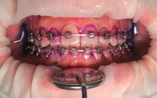 Zęby Aparacie Zęby Wynik Tabletek Wykrywania Bakterii Lub Płytki Nazębnej — Zdjęcie stockowe