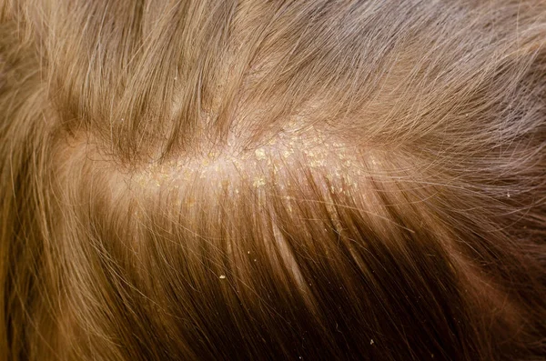 Dermatite Peau Sur Tête Bébé Image En Vente