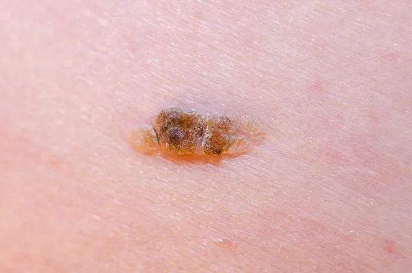 Nevus Keratoma Egy Felnőtt Közelkép Bőrén — Stock Fotó