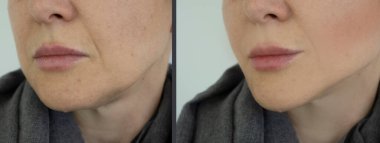 Kadın tedaviden önce ve sonra kırışıklıklarla karşılaşır