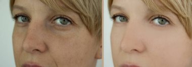 Kadın tedaviden önce ve sonra kırışıklıklarla karşılaşır