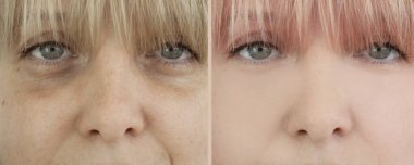 Kadın tedaviden önce ve sonra kırışıklıklarla karşılaşır