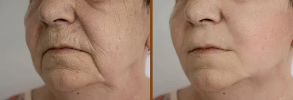 Морщины Лица Женщины После Лечения — стоковое фото
