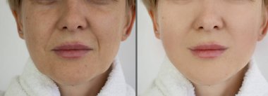 Kadın tedaviden önce ve sonra kırışıklıklarla karşılaşır