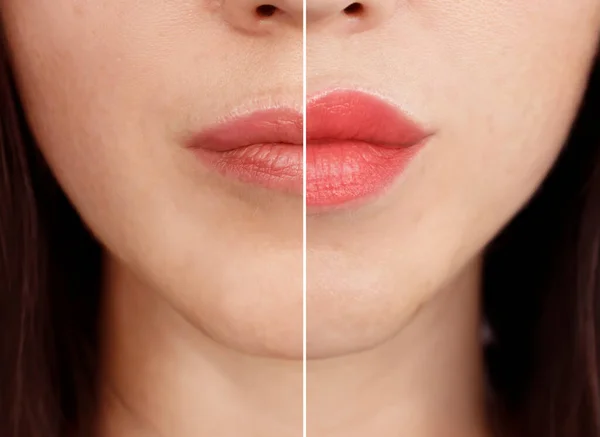 Gadis Bibir Sebelum Dan Setelah Augmentasi — Stok Foto