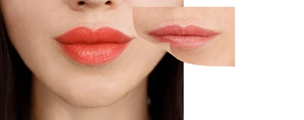 Meisje Lippen Voor Augmentatie — Stockfoto