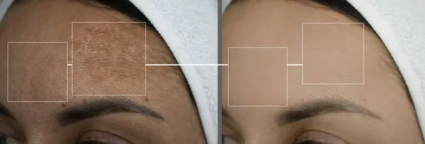 Stirnfalten Der Frau Vor Und Nach Der Behandlung — Stockfoto