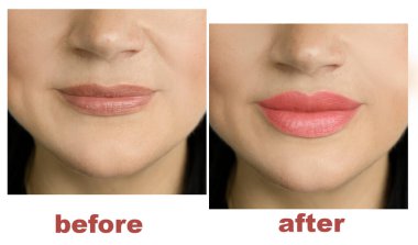 kız dudakları büyütme biçiminden önce ve sonra