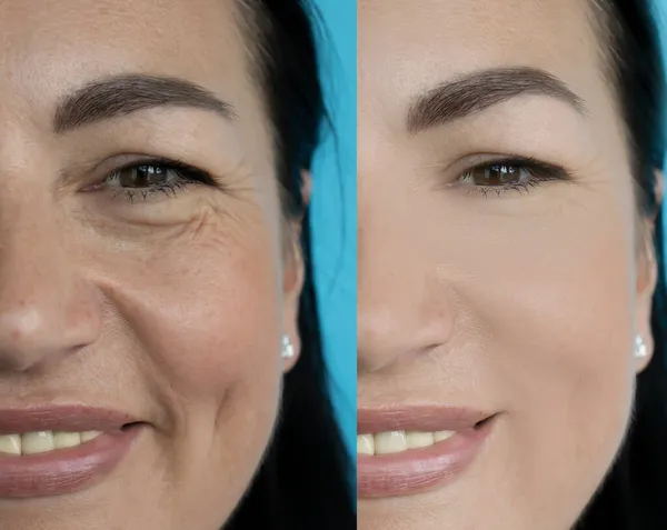 Woman Face Wrinkles Treatment — Stock Photo, Image