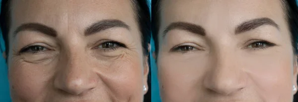 治療前と治療後の女性の顔のしわ — ストック写真