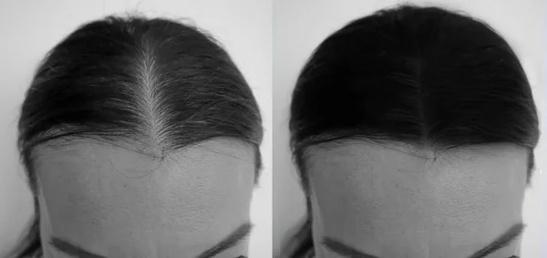 woman hair baldness before and after