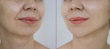 Kadın tedaviden önce ve sonra kırışıklıklarla karşılaşır