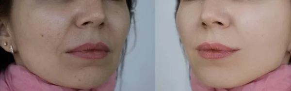 Arrugas Faciales Mujer Antes Después Del Tratamiento —  Fotos de Stock