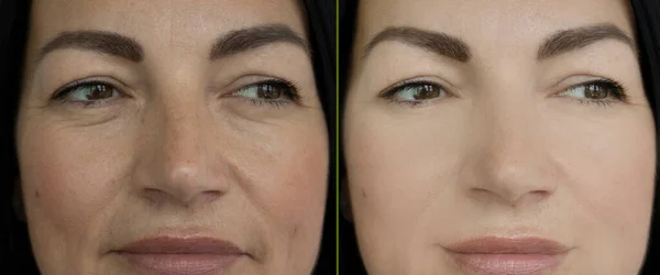 Woman Face Wrinkles Treatment — Stock Photo, Image