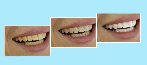 女性の歯ホワイトニング前後 — ストック写真