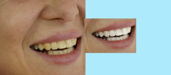 Жіночі Зуби Після Відбілювання — стокове фото