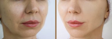 Kadın tedaviden önce ve sonra kırışıklıklarla karşılaşır