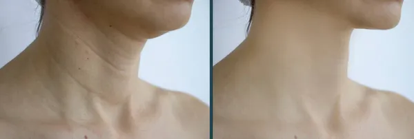 前と後の女性の首のしわ — ストック写真