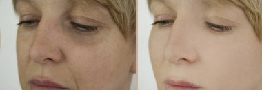 Kadın tedaviden önce ve sonra kırışıklıklarla karşılaşır