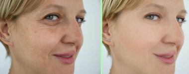 Kadın tedaviden önce ve sonra kırışıklıklarla karşılaşır