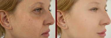 Kadın tedaviden önce ve sonra kırışıklıklarla karşılaşır