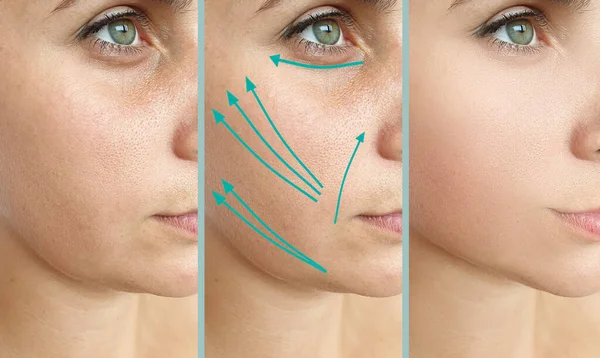 Woman Face Wrinkles Treatment — Stock Photo, Image