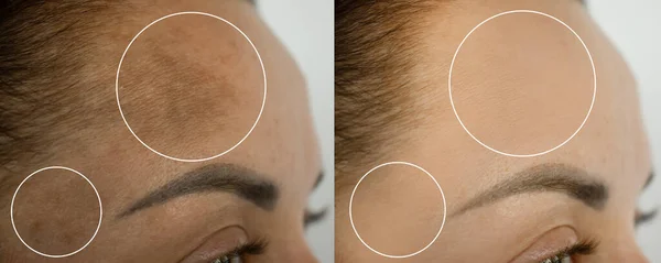 Woman Forehead Pigmentation Treatment — Zdjęcie stockowe