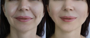 Kadın tedaviden önce ve sonra çift çene