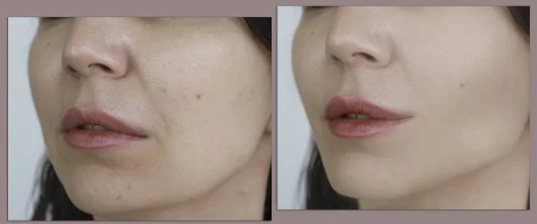 Woman Double Chin Treatment — Stock Photo, Image