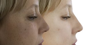 Kadın tedaviden önce ve sonra kırışıklıklarla karşılaşır