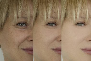 Kadın tedaviden önce ve sonra kırışıklıklarla karşılaşır