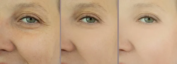 Falten Gesicht Der Frau Vor Und Nach Der Behandlung — Stockfoto