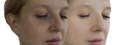 tedavi öncesi ve sonrası kadın kırışıklıkları yüz