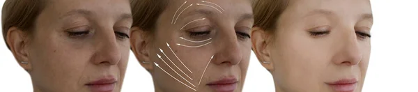 Face Woman Wrinkles Treatment — Stock Photo, Image