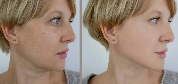 Frau Doppelkinn Vor Und Nach Der Behandlung — Stockfoto