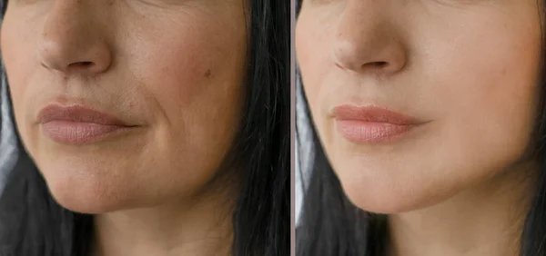 Arrugas Cara Mujer Antes Después — Foto de Stock