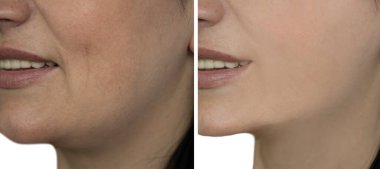 Kadın önce ve sonra kırışıklıklarla karşılaşır.