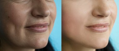 Kadın önce ve sonra kırışıklıklarla karşılaşır.