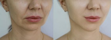 Kadın tedaviden önce ve sonra kırışıklıklarla karşılaşır