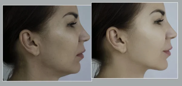 woman face wrinkles before and after treatment