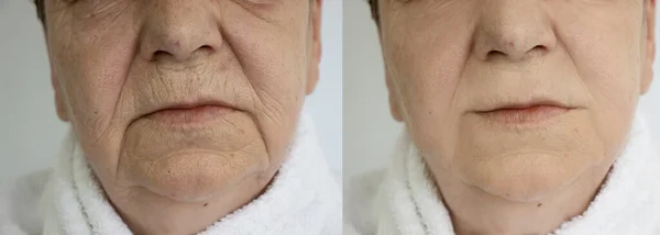 Ηλικιωμένη Γυναίκα Αντιμετωπίζουν Ρυτίδες Πριν Και Μετά Θεραπεία — Φωτογραφία Αρχείου