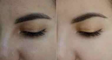 göz kadın tedavi öncesi ve sonrası kırışıklıklar