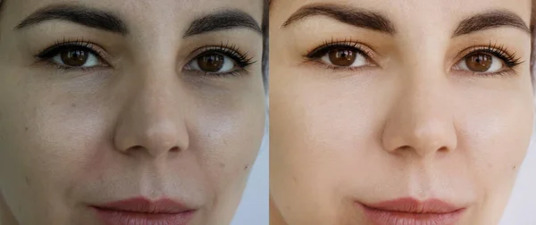 Göz Kadın Tedavi Öncesi Sonrası Kırışıklıklar — Stok fotoğraf
