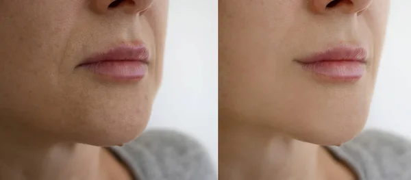 Falten Gesicht Der Frau Vor Und Nach Der Behandlung Mit — Stockfoto